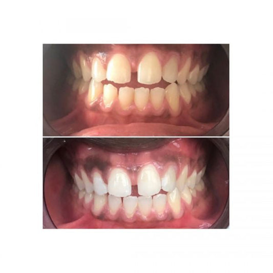 Duo blanchisseurs dentaire.