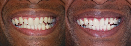 Teeth whitening duo.